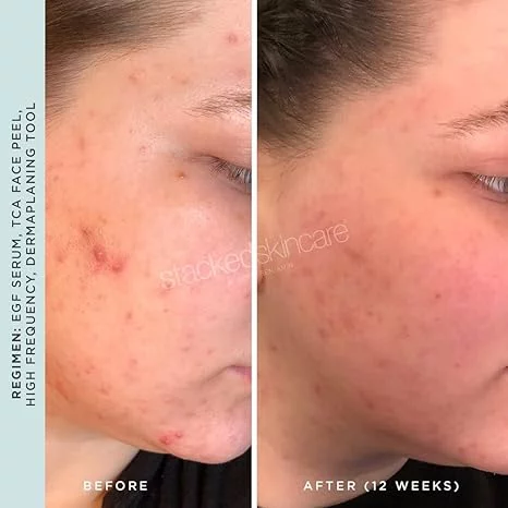 skin gym high frequency wand before and after